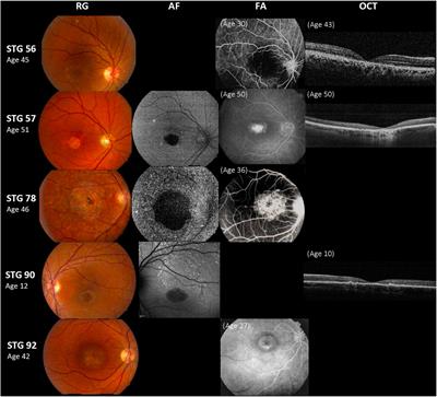 Clinical and Genetic Spectrum of Stargardt Disease in Argentinean Patients